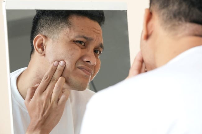 Jerawat Batu di Pipi, Kenali Penyebab dan Pengobatannya - Alodokter