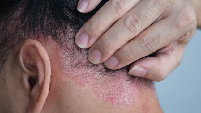 Dermatitis Seboroik