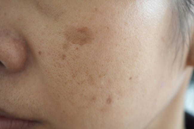Bintik Cokelat di Kulit Membuatmu Kurang Percaya Diri? Ini Cara Menghilangkannya - Alodokter