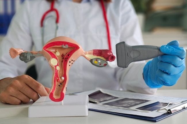 4 Ciri-Ciri Kista di Rahim yang Perlu Diketahui - Alodokter