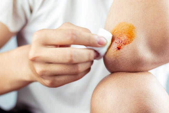 5 Cara Mengobati Luka Berair agar Cepat Kering yang Efektif - Alodokter