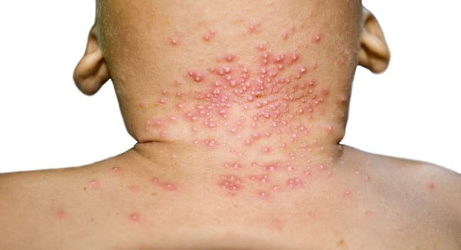 Molluscum Contagiosum