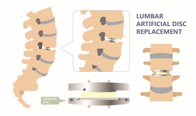 ACDF, Ini yang Harus Anda Ketahui - Alodokter