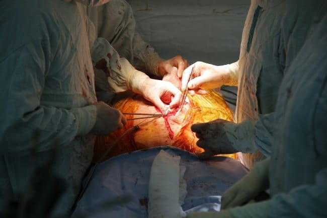 Transplantasi Paru dan Hal-hal Penting di Dalamnya - Alodokter