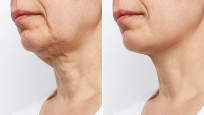 Neck Lift, Ini yang Harus Anda Ketahui - Alodokter