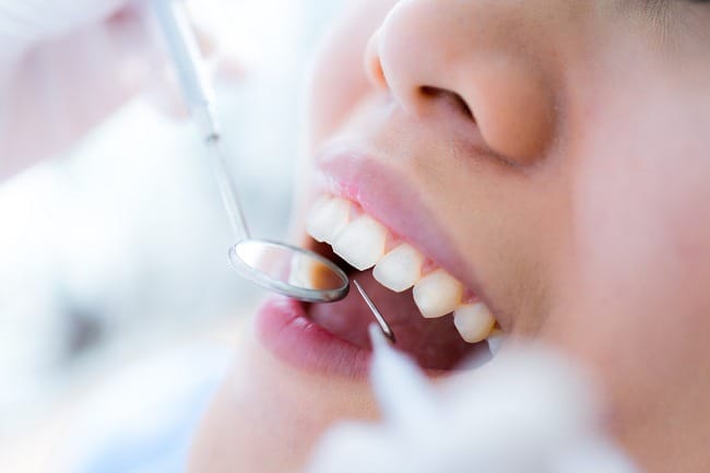 Ingin Melakukan Bonding Gigi? Cek Informasinya Berikut Ini - Alodokter
