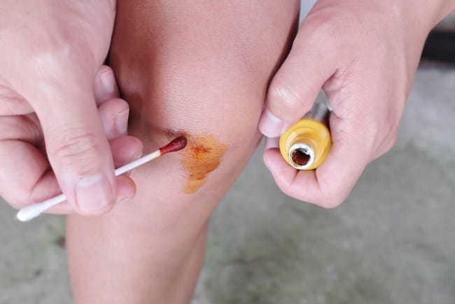 Luka Terbuka, Ini Cara Merawatnya agar Tidak Terinfeksi - Alodokter