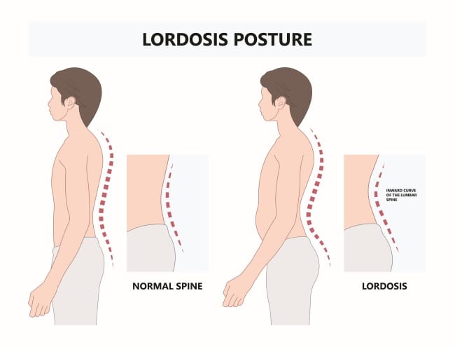 Lordosis