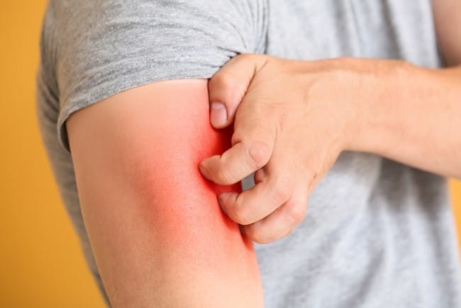 6 Obat Alergi Dingin yang Ampuh Redakan Gejala - Alodokter