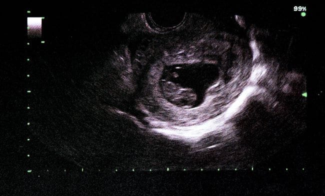 Janin 9 Minggu, Inilah Perkembangan dan Tips Menjaga Kesehatannya - Alodokter