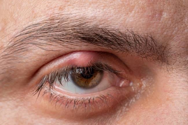 Mata Bengkak Sebelah Kanan, Inilah Penyebab dan Cara Mengatasinya - Alodokter