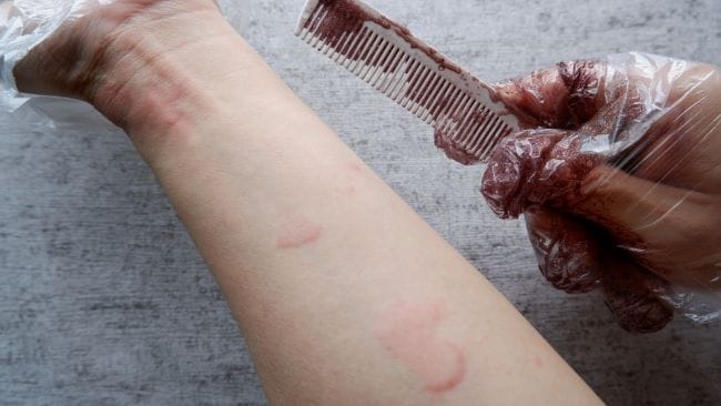 Apakah Alergi Cat Rambut Bisa Sembuh? Ini Jawabannya - Alodokter