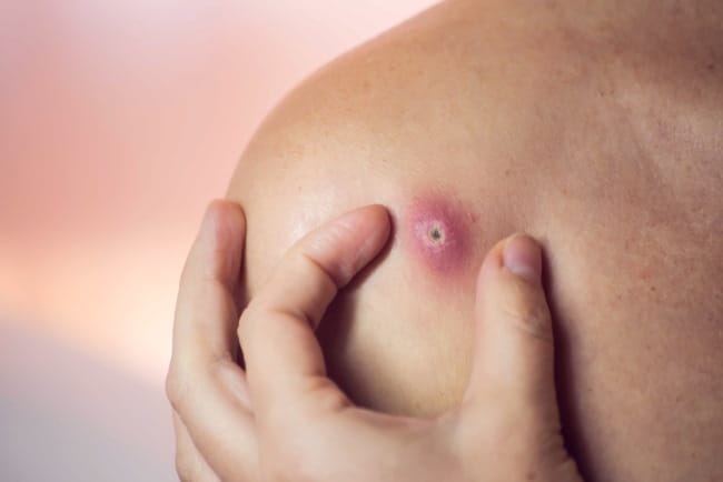 5 Cara Mengeluarkan Mata Bisul dengan Aman dan Efektif - Alodokter