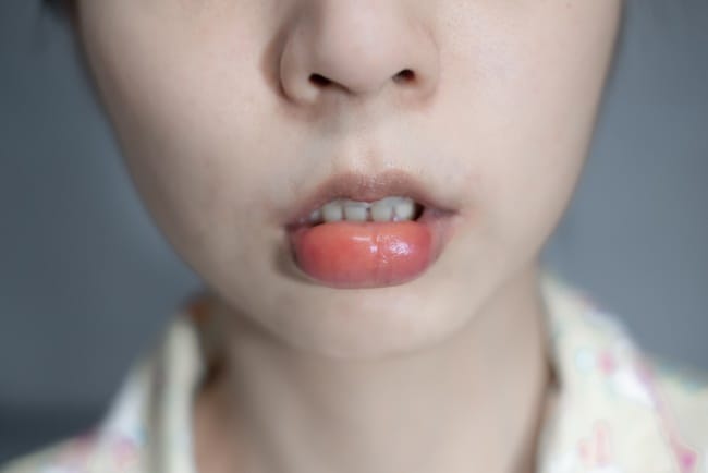 7 Penyebab Bibir Bengkak dan Cara Mengatasinya - Alodokter