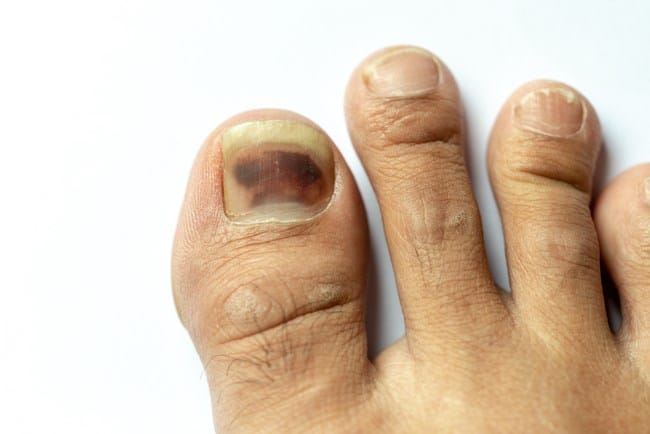 Melanoma Kuku, Ketahui Faktor Risiko dan Penanganannya - Alodokter