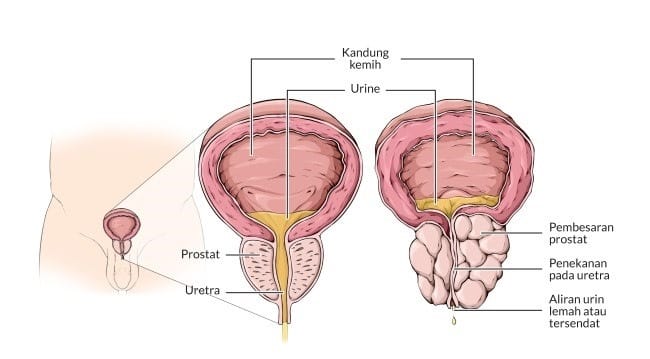 BPH (Benign Prostatic Hyperplasia)