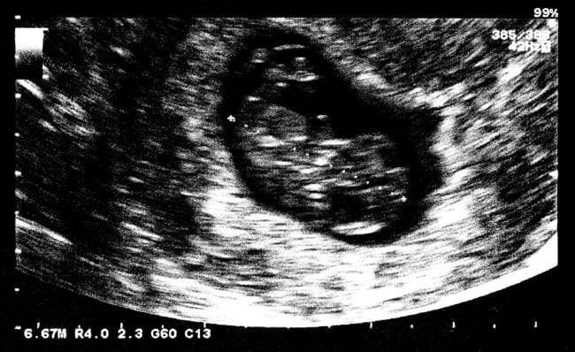 Janin 7 Minggu, Inilah Perkembangan dan Tips Menjaga Kesehatannya - Alodokter