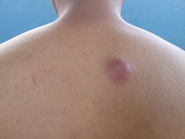 Bisul di Punggung, Ketahui Penyebab dan Cara Mengatasinya - Alodokter