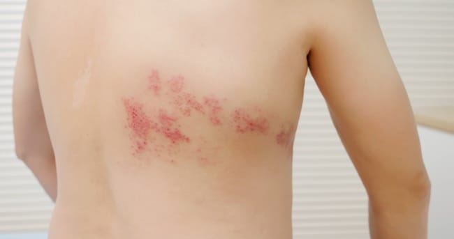 Herpes di Punggung, Kenali Gejala dan Pengobatannya - Alodokter