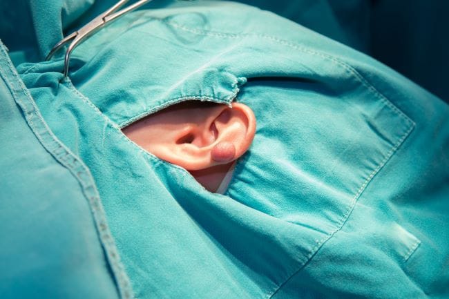 Operasi Keloid, Ini yang Harus Anda Ketahui - Alodokter