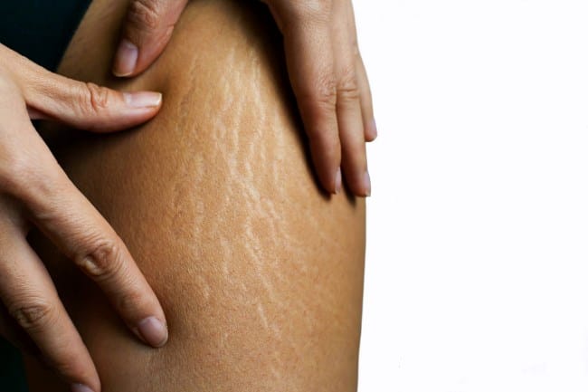 Menghilangkan Stretch Mark