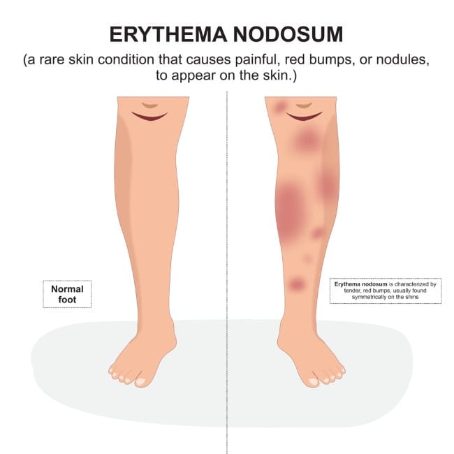 Eritema Nodosum