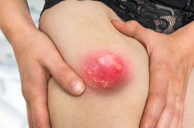 6 Cara Agar Bisul Cepat Pecah - Alodokter
