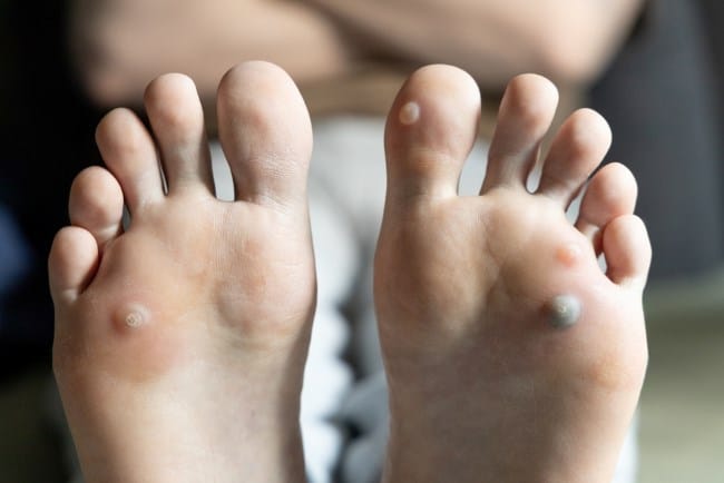 Benjolan di Telapak Kaki, Inilah Penyebab dan Penanganannya - Alodokter