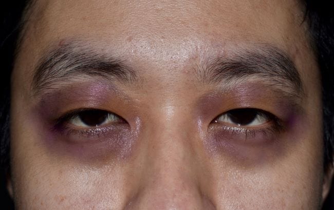 Racoon Eyes, Kenali Penyebab, Gejala, dan Penanganannya - Alodokter