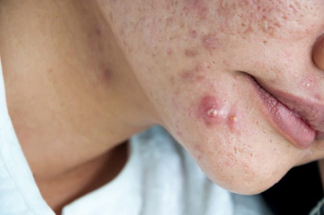 6 Perbedaan Bisul dan Jerawat yang Penting Diketahui - Alodokter