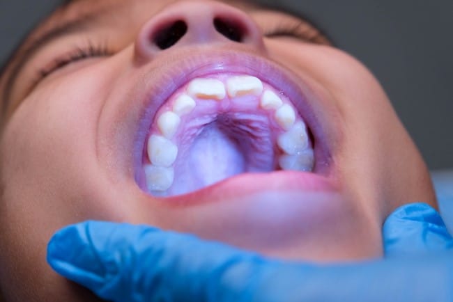 Langit-langit Mulut Gatal, Ini Penyebab dan Cara Mengatasinya - Alodokter