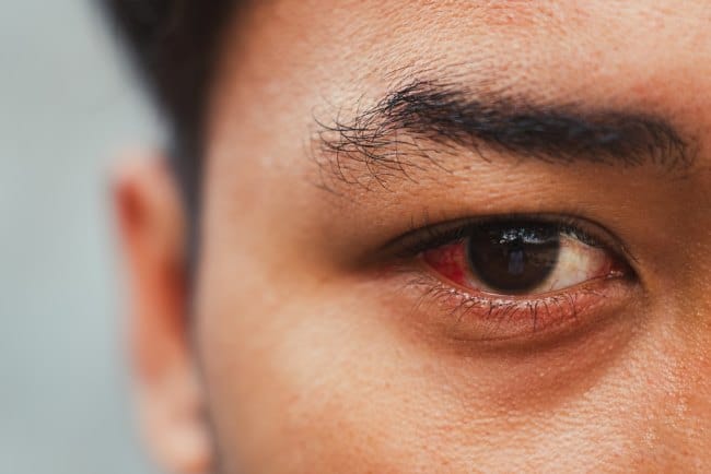 Cara Mengobati Bercak Merah pada Mata dengan Cepat - Alodokter
