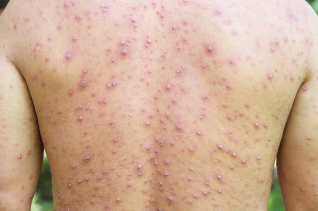 4 Perbedaan Cacar Air dan Cacar Api yang Perlu Dipahami - Alodokter