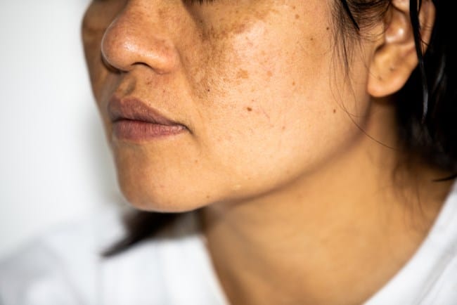 5 Cara Menghilangkan Belang di Wajah dalam 1 Hari - Alodokter