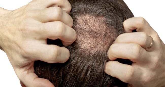6 Vitamin untuk Rambut Rontok Terbaik - Alodokter