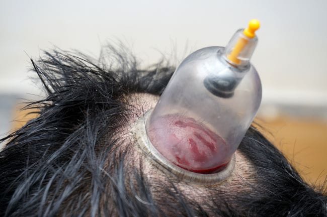 Bekam Kepala, Inilah Ragam Manfaat, Risiko, dan Hal yang Perlu Diperhatikan - Alodokter