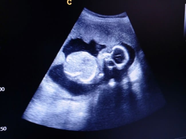 Janin 19 Minggu, Kenali Perkembangan dan Tips Menjaga Kesehatannya - Alodokter