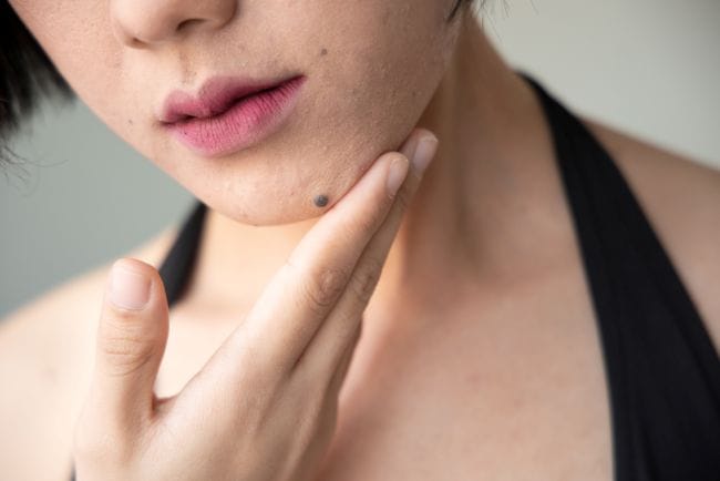 Tahi Lalat Gatal Apakah Berbahaya? Cek Penjelasannya di Sini! - Alodokter