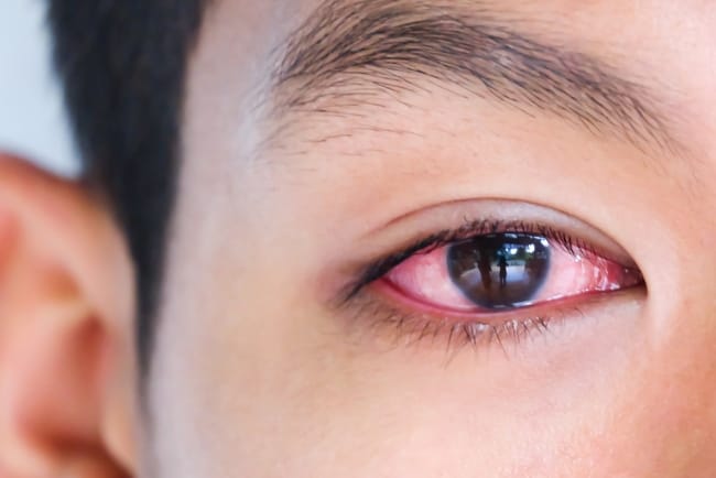 6 Cara Menghilangkan Mata Merah dengan Cepat - Alodokter