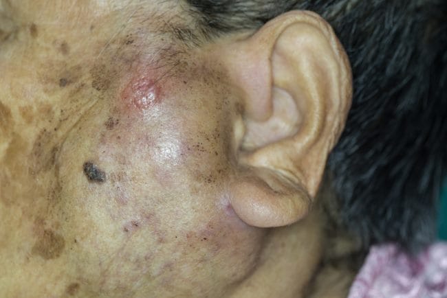 Benjolan di Pipi Dekat Telinga, Kenali Penyebab dan Penanganannya - Alodokter