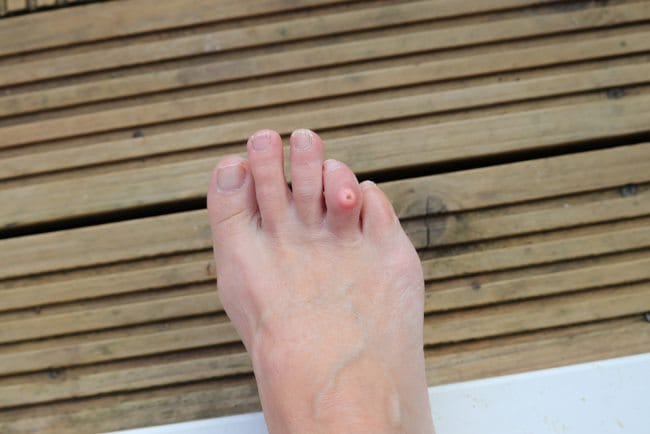 4 Cara Mengobati Mata Ikan di Kaki dengan Aman dan Efektif - Alodokter