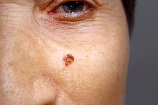 Kanker Kulit Wajah, Kenali Jenis, Gejala, dan Penyebabnya - Alodokter
