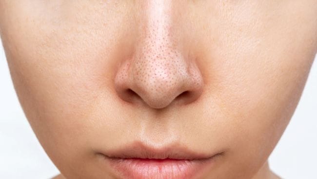 Perbedaan Sebaceous Filament dengan Komedo - Alodokter