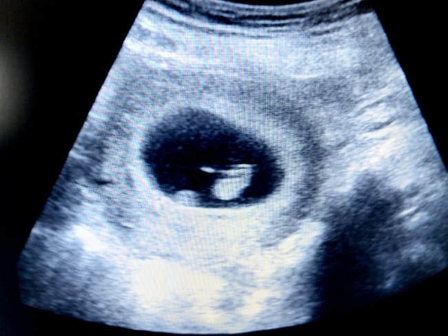 Janin 5 Minggu, Inilah Perkembangan dan Tips Menjaga Kesehatannya - Alodokter