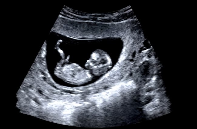 Berat Normal Janin 36 Minggu dan Tips Menjaganya - Alodokter