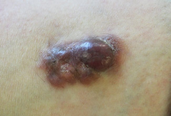 5 Kanker Langka yang Perlu Diketahui dan Cara Mendeteksinya - Alodokter