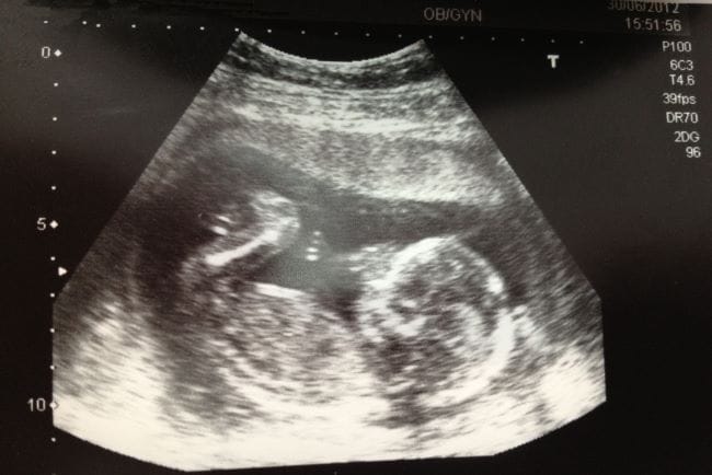 USG Janin 4 Bulan, Ini yang Bisa Terlihat dalam Kandungan - Alodokter