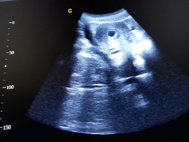 Kantung Janin 6 Minggu, Ketahui Ukuran dan Perkembangannya - Alodokter