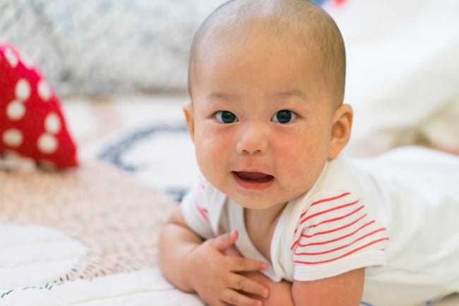 Agar Campak pada Bayi Cepat Keluar, Ini Cara Merawatnya - Alodokter