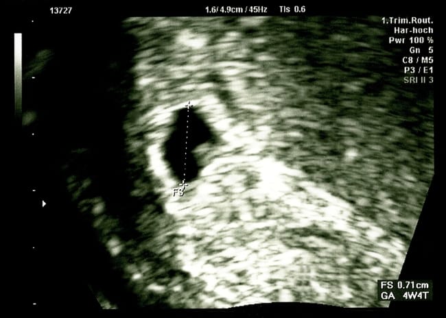 Kantung Janin 4 Minggu, Ini Ukuran dan Perkembangannya - Alodokter